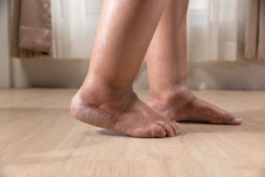 Common Causes of Swelling in the Feet