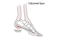 Evaluating Treatment Paths for Painful Heel Growths