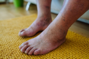 Recognizing Serious Foot Problems Related to Diabetes
